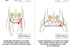 Carriers and hip dysplasia in babies